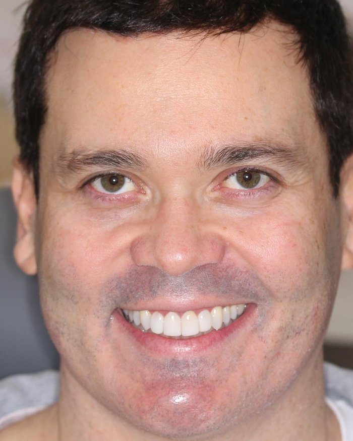 Patient after veneer treatment