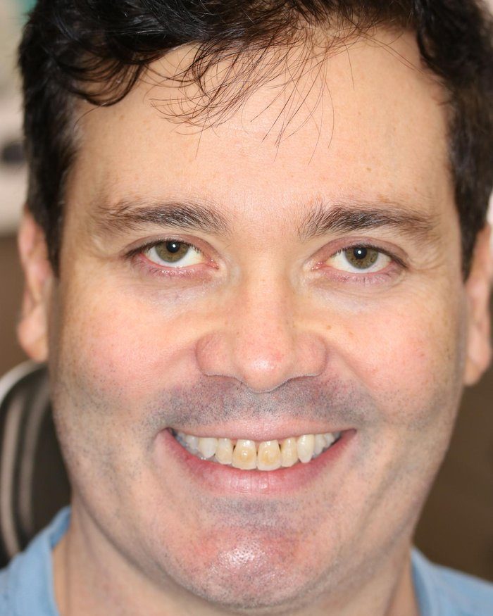 Patient before veneer treatment