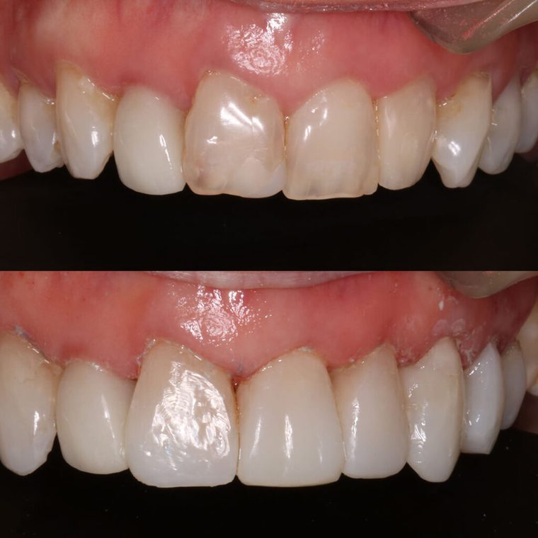 Before and after direct composite veneers on upper teeth