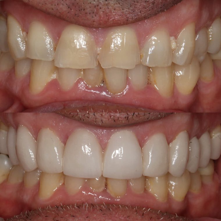 Before and after full upper veneer transformation