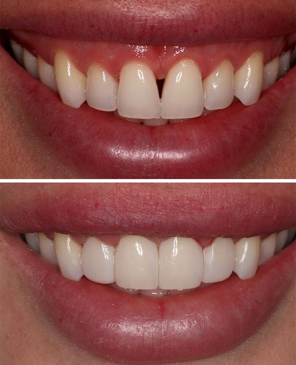 Before and after closing a gap between front teeth